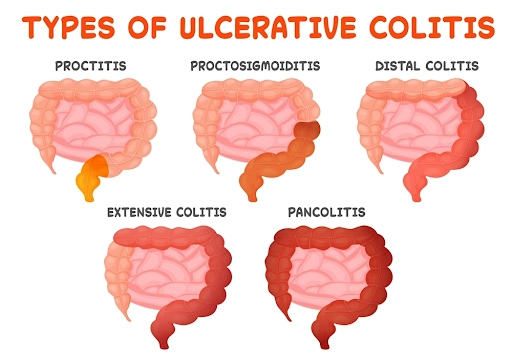 types of ulcerative colitis